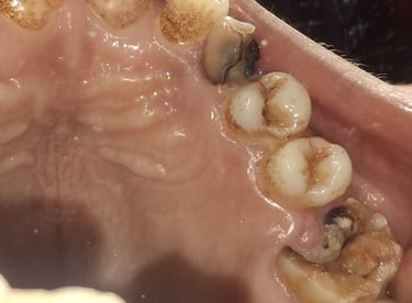 multiple carious teeth with pain loss of chewing shree dental care