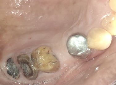 clinical image of root pieces in mouth st shree dental care