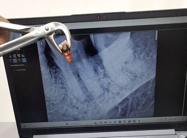 Severely decayed tooth removed using safe extraction technique at shree dental care ahmeda