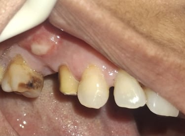 swelling in bone near molar teeth due to long term caries requiring tooth extraction