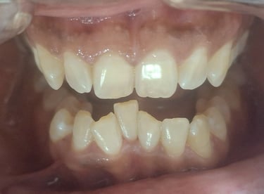 teeth cleaning results for mild crooked teeth at shree dental care near shyamal