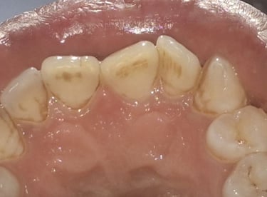 Teeth cleaning result showing tartar buildup before treatment near Shyamal shree dental care