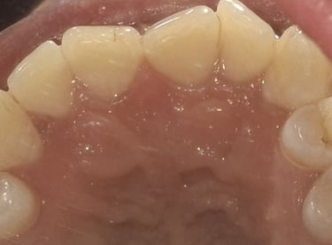 Teeth cleaning result after removal of tartar and deposits near Shyamal at shree dental care