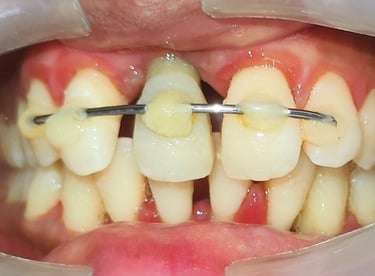  Teeth cleaning result healthy teeth and gums after proper cleaning  shree dental care near shyamal