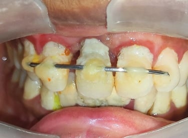  Teeth cleaning results plaque deposits on gumline before cleaning near Shyamal at shree dental care