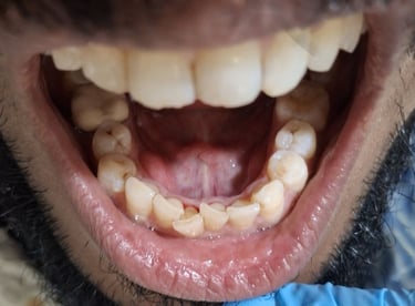  Teeth cleaning result after removal of tobacco stains at shree dental care near shyamal