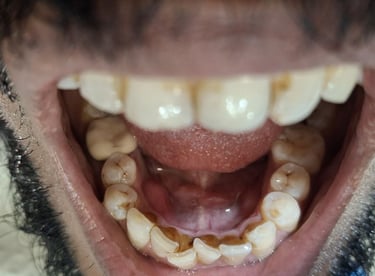 Teeth cleaning result showing tobacco stains before dental cleaning at shree dental care  