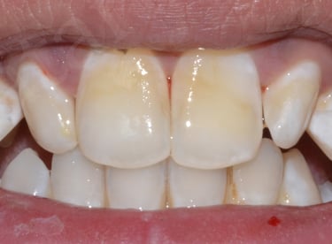 After whitening showing blended shade and improved appearance at Shree Dental Care Shyamal Ahmedabad