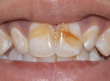 Before whitening showing deep fluorosis spots in Shyamal Ahmedabad