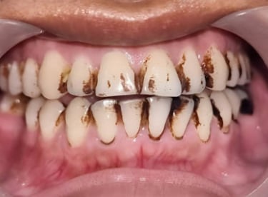 Before whitening showing nicotine-induced brown stains in Shyamal Ahmedabad