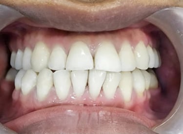 After whitening showing clean, lighter enamel tone at Shree Dental Care Shyamal Ahmedabad