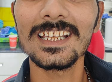 before cleaning showing improved tooth brightness at Shree Dental Care Shyamal Ahmedabad
