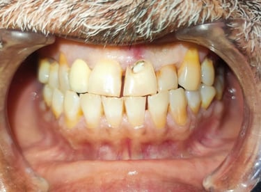 before tooth colored filling in front tooth at shyamal ahmedabad 