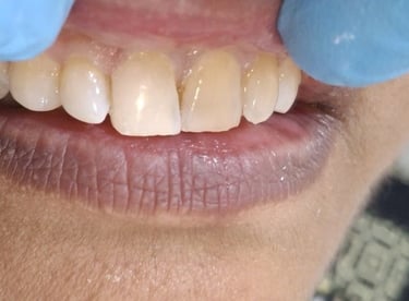 Tooth colored filling after replacing old filling for improved aesthetics in Shyamal Ahmedabad