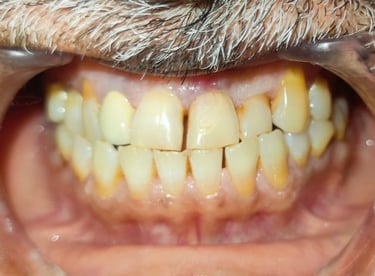 after tooth colored filling in front tooth showing healthy tooth at shree dental shyamal ahmedabad