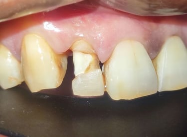 before tooth colored filling in front tooth at shyamal ahmedabad