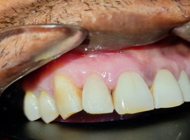 after tooth colored filling in front tooth at shyamal ahmedabad shree dental care