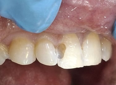Old discolored dental filling before replacement with tooth colored filling in Shyamal Ahmedabad