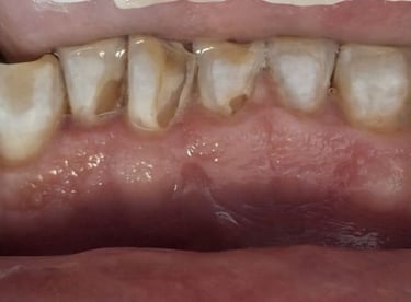 Broken front tooth edge before tooth colored filling restoration in Shyamal Ahmedabad