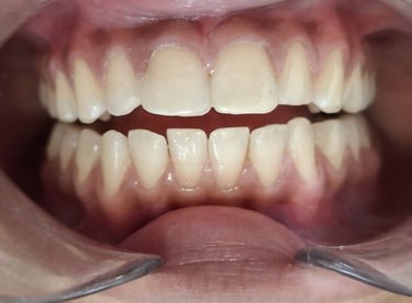 Restored broken tooth using tooth colored filling with natural shape in Shyamal Ahmedabad