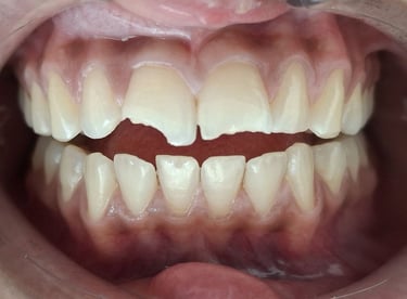 Broken front teeth edge before tooth colored filling Shyamal Ahmedabad