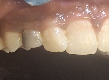 carious canine retained between upper front permanent teeth at shree dental care