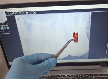 very big upper third molar removed with proper technique at shree dental care near shyamal