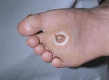 diabetic foot ulcer