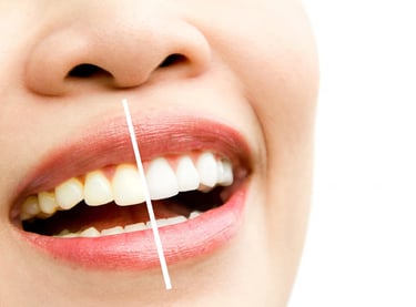 teeth whitening before and after