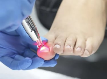 Tratamiento-laser-onicomicosis