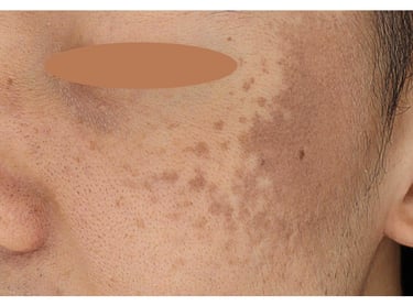 nevus of ota birthmark singapore