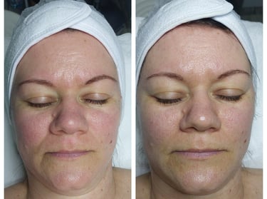 C vitaminos arckezelés veszprémben