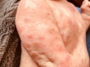 Eczéma présent sur tout le corps d'un bébé avec de grandes plaques