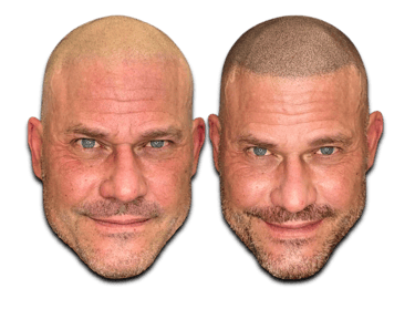 a before/after photo of a man who has received an SMP treatment on his scalp