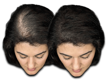 a before/after photo of a woman who has received an SMP treatment on her scalp