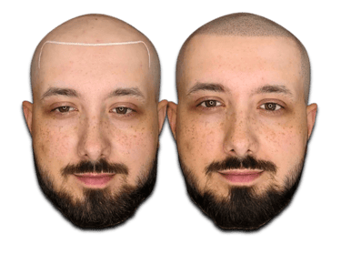 a before/after photo of a man who has received an SMP treatment on his scalp