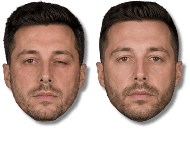 Before and after comparison of ptosis correction surgery on a man with a drooping eyelid.