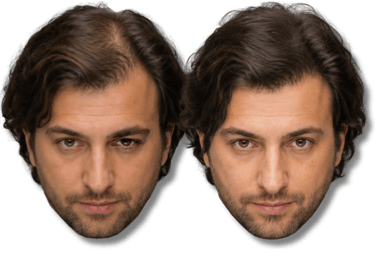 Before and after comparison of a man with thinning hair using hair loss restoration treatment.