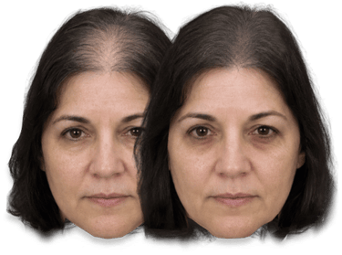 Before and after comparison of a woman showing female hair loss thinning and successful SMP results.