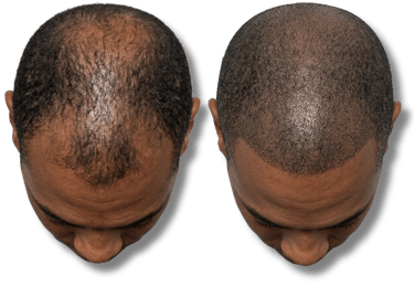 Before and after comparison of scalp micropigmentation for male pattern baldness and hair density.