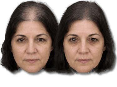 Before and after results showing female SMP hair loss treatment on a middle-aged woman.