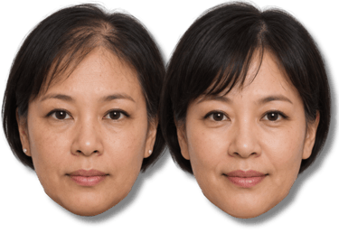 Before and after SMP hair loss treatment results for an Asian woman with thinning hair on the crown.