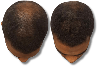 Before and after hair restoration results showing crown density improvement on a male scalp.
