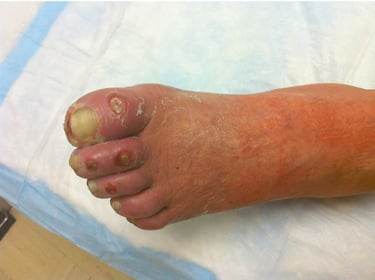 arterial ischemic ulcers