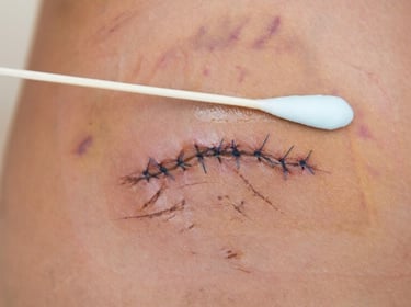 Applying ointment with a cotton swab to a surgical incision closed with blue stitches for wound care.