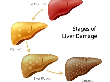 Cirrhosis of liver GASTRO FOUNDATION