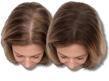 Before and after comparison of female hair loss treatment showing thicker hair and improved scalp coverage.