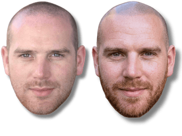 Before and after scalp micropigmentation results on a man with a shaved head and beard.