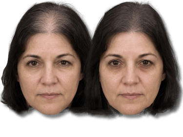 Before and after results showing female SMP hair loss treatment on a middle-aged woman.
