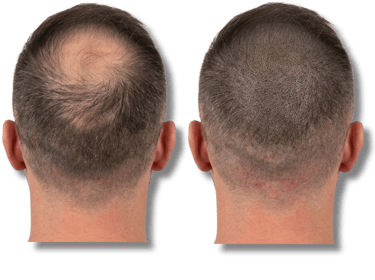 Before and after scalp micropigmentation for male pattern baldness and thinning crown.
